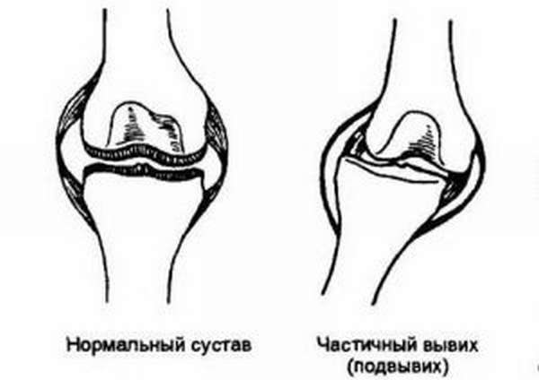 Дисплазия колена